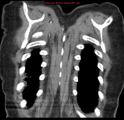 Bronchoalveolar carcinoma (BAC) (Radiopaedia 13436-13392 E 55).jpg