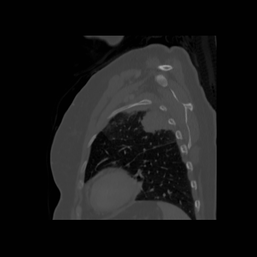 Bronchogenic carcinoma (Radiopaedia 73497-84262 Sagittal bone window 122).jpg