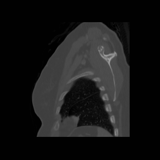 Bronchogenic carcinoma (Radiopaedia 73497-84262 Sagittal bone window 131).jpg