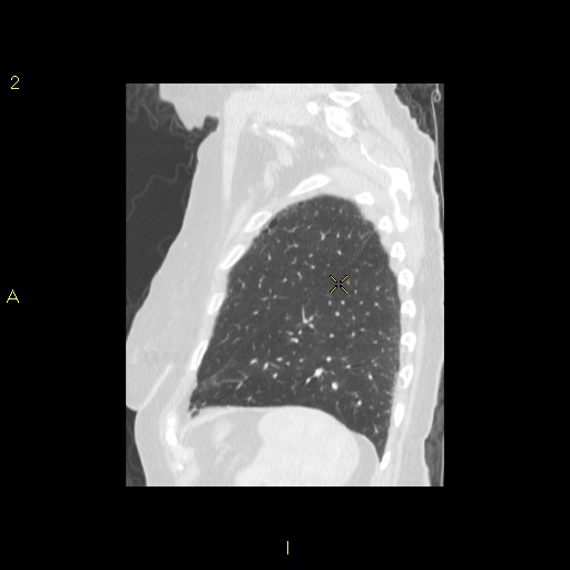 File:Bronchogenic carcinoma as an incidental finding (Radiopaedia 16453-16130 Sagittal lung window 11).jpg
