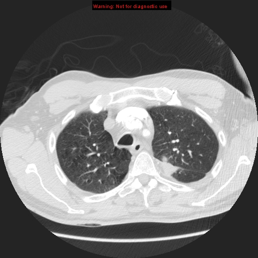 File:Bronchogenic carcinoma brain metastasis (Radiopaedia 9286-105832 Axial lung window 25).jpg