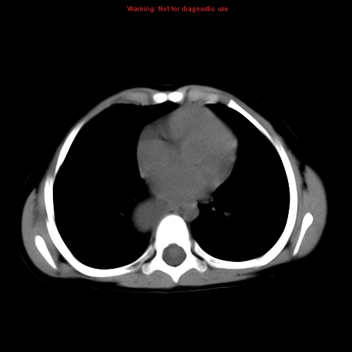 File:Bronchogenic cyst (Radiopaedia 9372-10063 Axial non-contrast 11).jpg