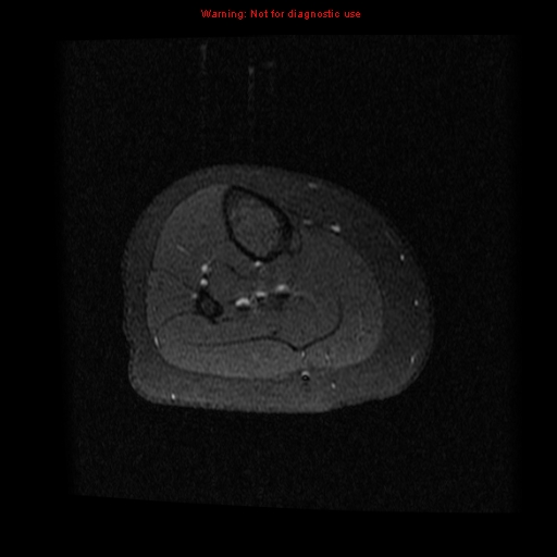 File:Brown tumor (Radiopaedia 12318-12597 Axial T1 C+ fat sat 23).jpg