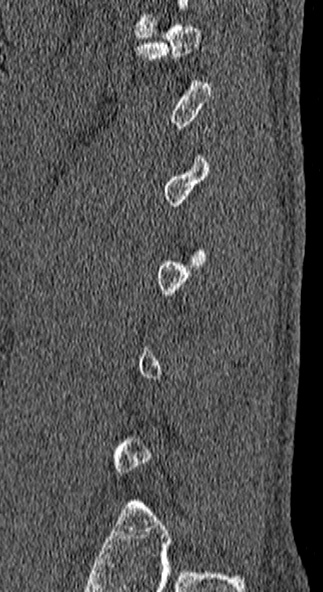 Burst fracture (Radiopaedia 53373-59357 Sagittal bone window 7).jpg