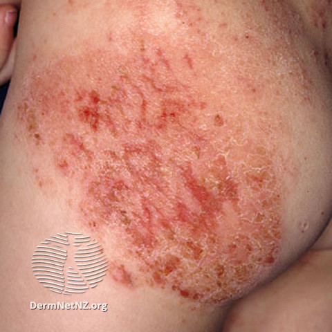 File:Buttock eczema (DermNet NZ dermatitis-s-atopic23).jpg