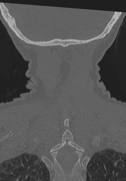 C2 fracture with vertebral artery dissection (Radiopaedia 37378-39199 Coronal bone window 50).png