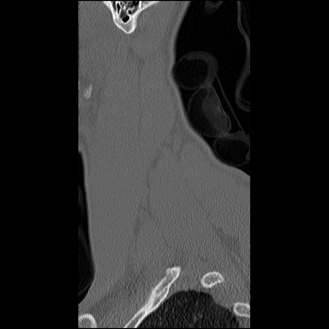 C5 facet fracture (Radiopaedia 58374-65499 Sagittal bone window 10).jpg