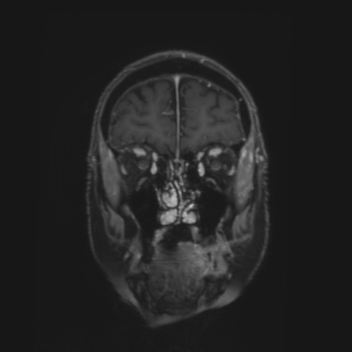CNS lymphoma with steroid response (Radiopaedia 37980-39921 Coronal T1 C+ 4).png
