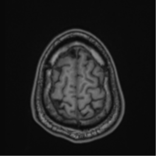 CNS vasculitis (Radiopaedia 55715-62263 Axial T1 91).png