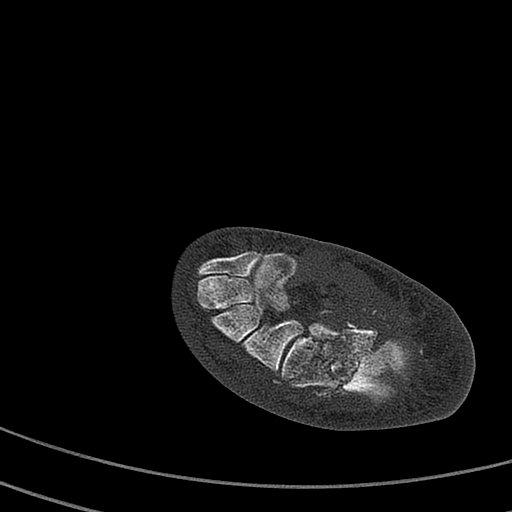 File:Calcaneal fracture - Sanders type 4 (Radiopaedia 90179-107370 Axial bone window 38).jpg