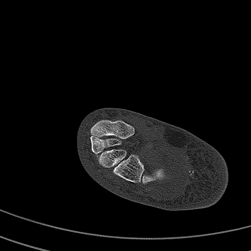 Calcaneal fracture - Sanders type 4 (Radiopaedia 90179-107370 Axial bone window 41).jpg
