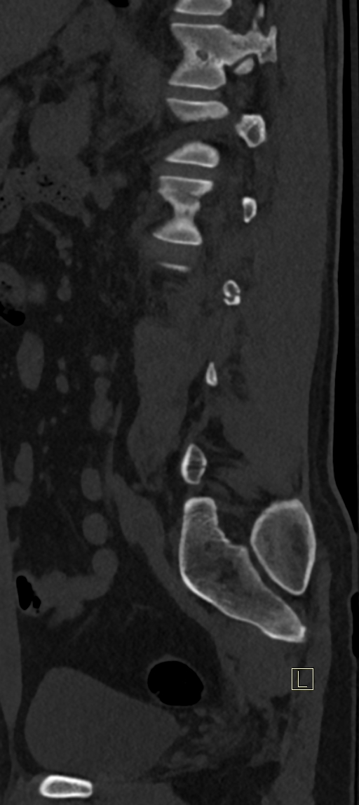 Calcaneal fractures with associated L2 burst fracture (Radiopaedia 71671-82493 Sagittal bone window 17).jpg