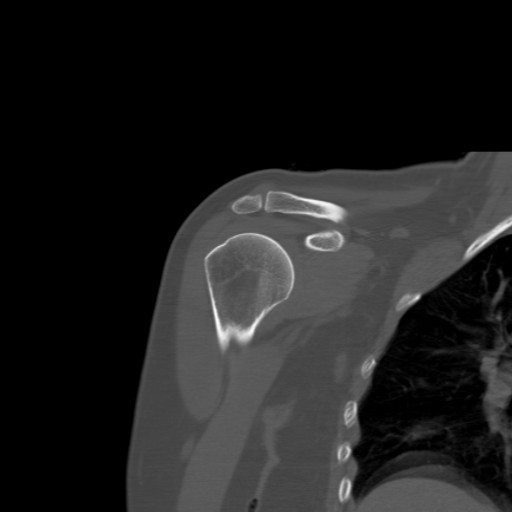 File:Calcific tendinitis of the infraspinatus tendon (Radiopaedia 87256-103539 Coronal bone window 23).jpg