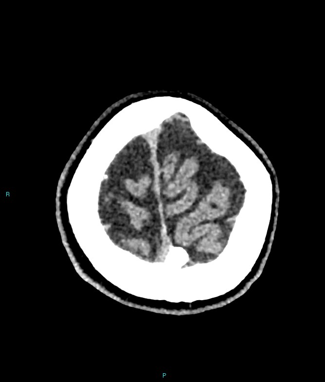 Calcified cerebral emboli from left ventricular thrombus (Radiopaedia 84420-99758 Axial non-contrast 12).jpg