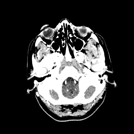 File:Calcified cerebral hydatid cyst (Radiopaedia 65603-74717 Axial with contrast 4).jpg