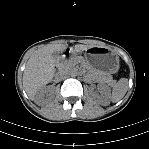 File:Calcified hepatic hydatid cyst (Radiopaedia 83870-99072 Axial non-contrast 62).jpg
