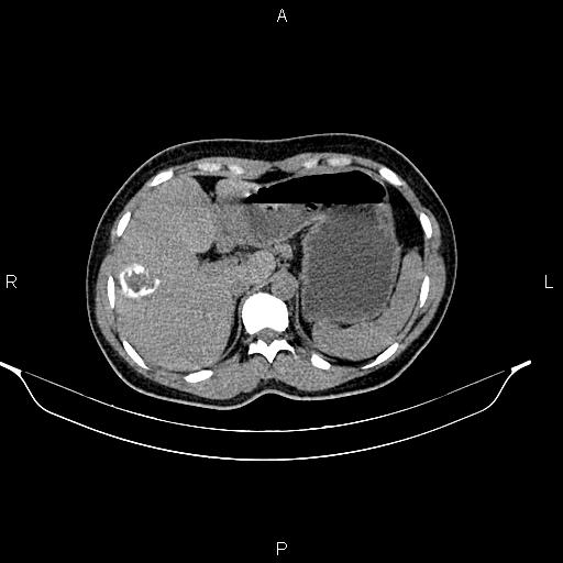 File:Calcified hepatic hydatid cyst (Radiopaedia 84672-100095 Axial non-contrast 26).jpg