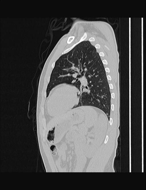 Calcifying pulmonary metastases (Radiopaedia 33359-34396 Sagittal lung window 21).jpg