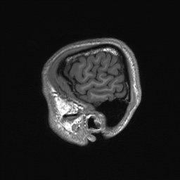 Callosal dysgenesis with interhemispheric cyst (Radiopaedia 53355-59335 Sagittal T1 158).jpg
