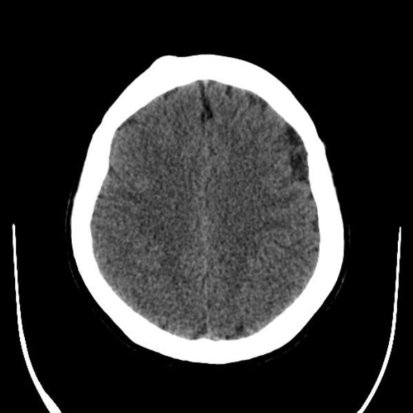 File:Calvarial osteoma (Radiopaedia 36520-38079 Axial non-contrast 40).jpg