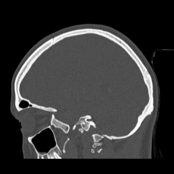Calvarial osteoma (Radiopaedia 36520-38079 Sagittal bone window 71).jpg