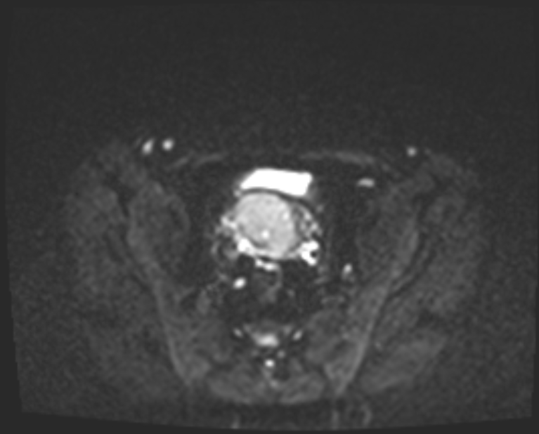 Cancer cervix - stage IIb (Radiopaedia 75411-86615 Axial DWI 20).jpg