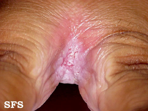 File:Candidiasis (Dermatology Atlas 2).jpg