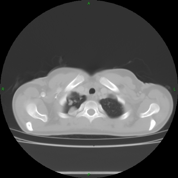 File:Cannon ball metastases - synovial sarcoma (Radiopaedia 26135-26271 Axial lung window 5).jpg