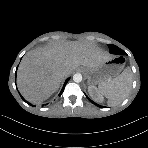 Cannonball metastases - testicular choriocarcinoma (Radiopaedia 84510-99891 B 97).jpg