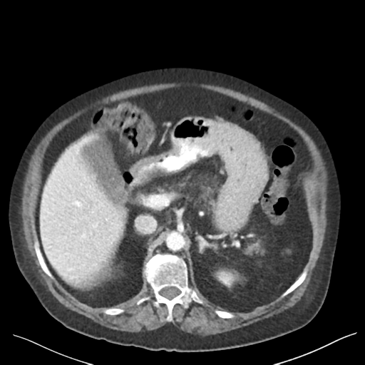 Cannonball metastases from endometrial cancer (Radiopaedia 42003-45031 E 26).png