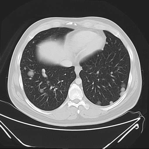 File:Cannonball pulmonary metastases (Radiopaedia 67684-77101 Axial lung window 19).jpg