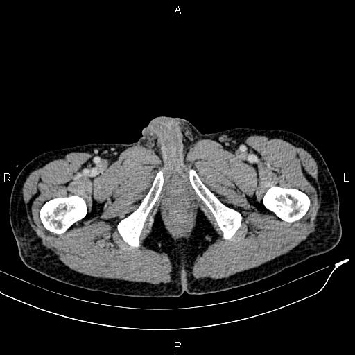 File:Caput medusae sign - portal hypertension (Radiopaedia 64007-72759 A 110).jpg