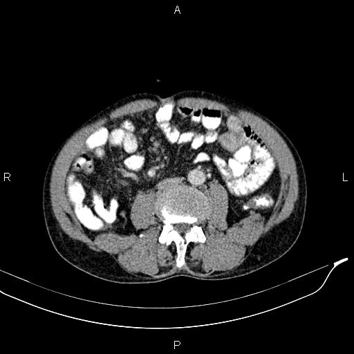 File:Caput medusae sign - portal hypertension (Radiopaedia 64007-72759 A 56).jpg