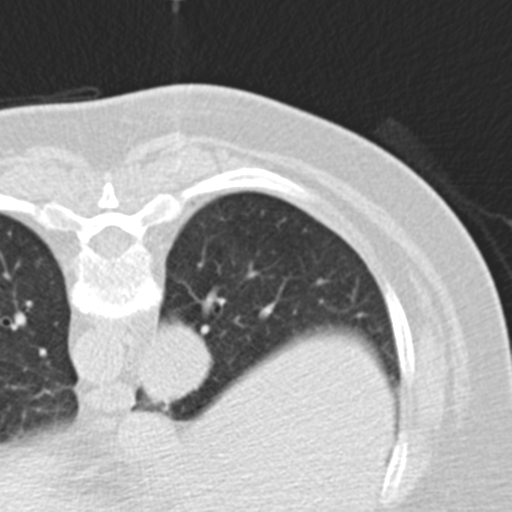 Carcinoid tumor - lung (Radiopaedia 44814-48644 Axial lung window 47).png