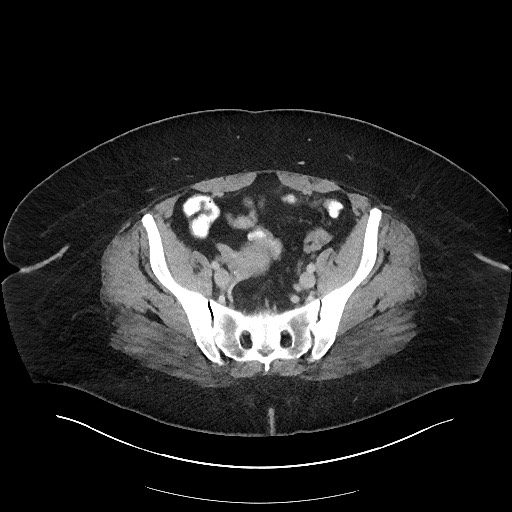 Carcinoid tumor - terminal ileum (Radiopaedia 60931-68739 A 104).jpg