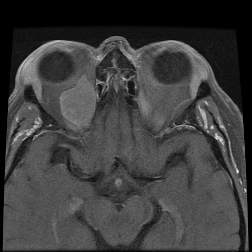 File:Carcinoid tumor of the ileum with metastasis to orbit (Radiopaedia 28165-28424 Axial T1 C+ fat sat 10).jpg