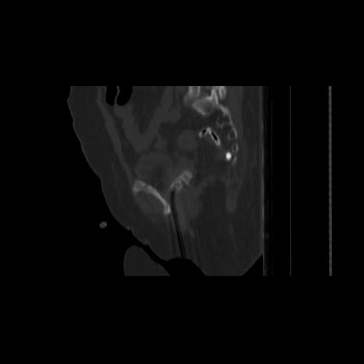 Carcinoma cervix- brachytherapy applicator (Radiopaedia 33135-34173 Sagittal bone window 114).jpg
