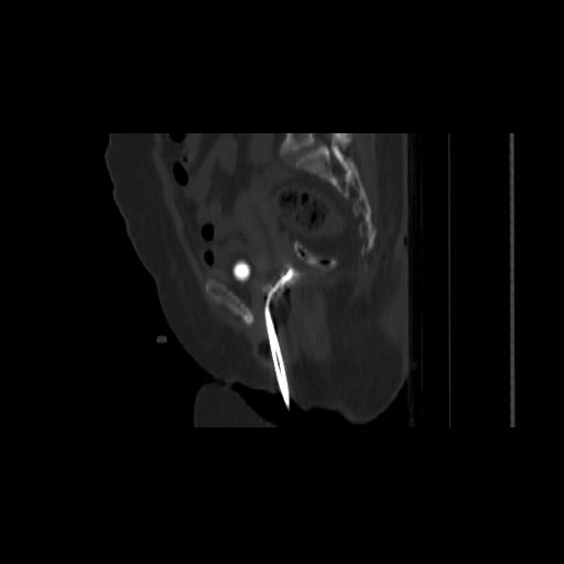 File:Carcinoma cervix- brachytherapy applicator (Radiopaedia 33135-34173 Sagittal bone window 77).jpg
