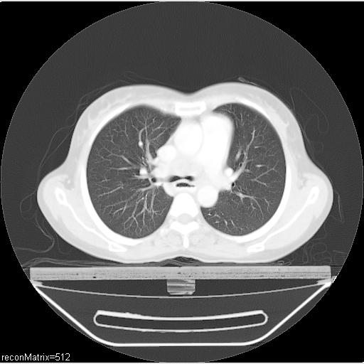 File:Carcinoma of esophagus (Radiopaedia 27356-27550 Axial lung window 21).jpg