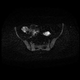 Carcinoma of the cervix (Radiopaedia 89018-105858 Axial DWI 40).jpg