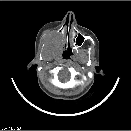 Carcinoma of the maxillary antrum (Radiopaedia 53805-59888 Axial non-contrast 58).jpg