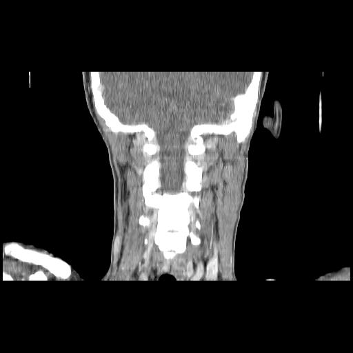 Carcinoma of the maxillary antrum (Radiopaedia 53805-59888 Coronal C+ delayed 119).jpg
