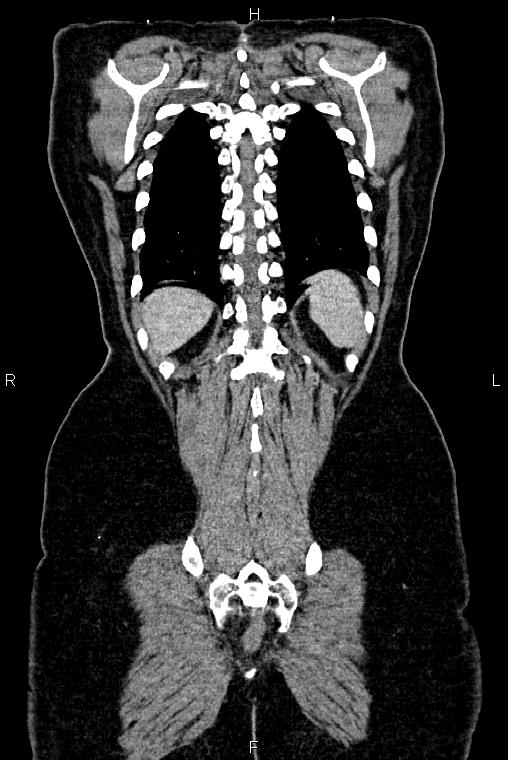 Carcinoma of uterine cervix (Radiopaedia 85861-101700 C 51).jpg