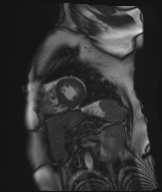 Cardiac amyloidosis (Radiopaedia 51404-57150 Sagittal CINE SSFP 105).jpg