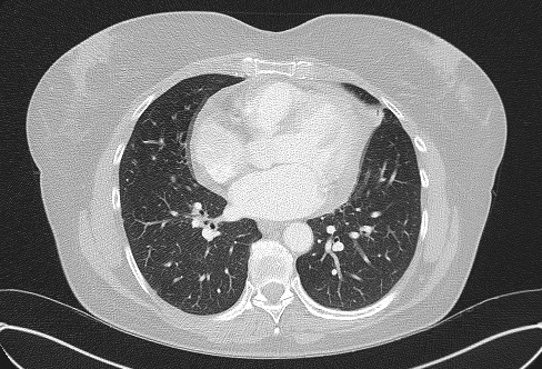 Cardiac sarcoidosis (Radiopaedia 74548-85534 Axial lung window 53).jpg