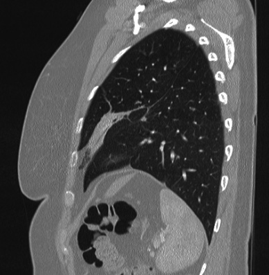 Cardiac sarcoidosis (Radiopaedia 74548-85534 Sagittal lung window 18).jpg