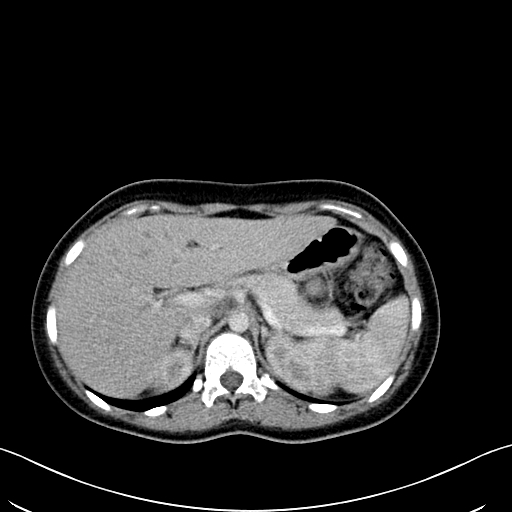 Caroli disease with medullary sponge kidney (Radiopaedia 82622-96804 C 21).jpg