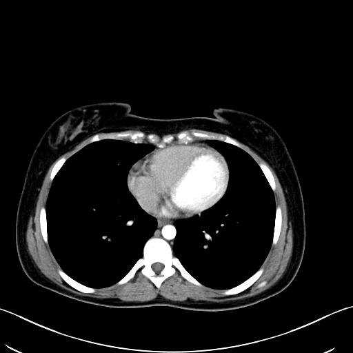 Caroli disease with medullary sponge kidney (Radiopaedia 82622-96804 C 5).jpg