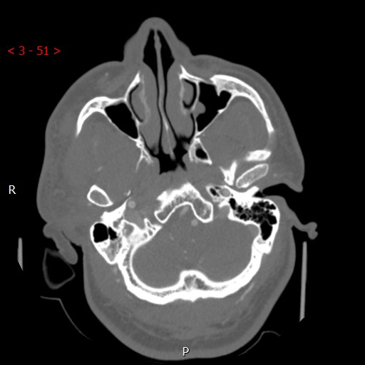 Caroticocavernous fistula (Radiopaedia 42346-45457 A 9).jpg