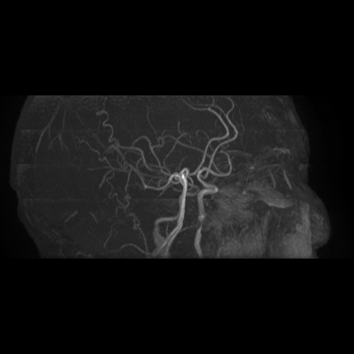 Carotid arterial dissection with acute cerebral infarction (Radiopaedia 26636-26784 MRA 17).jpg